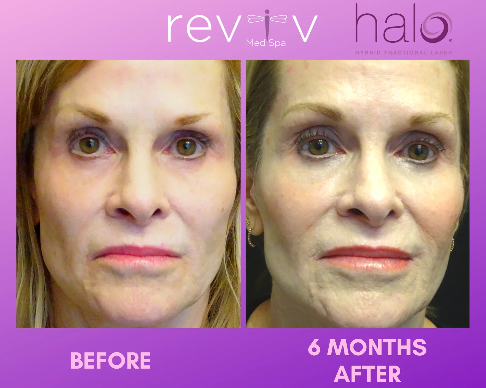 Reviv patient — Halo (undefined)