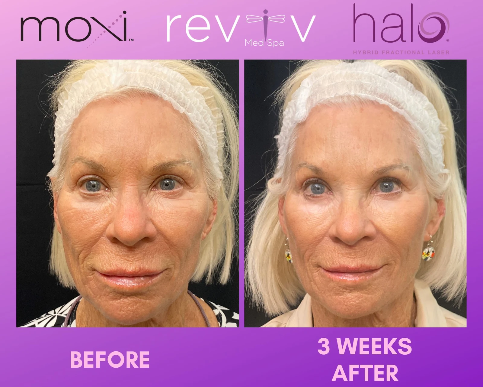 Reviv patient — Halo + MOXI (undefined)