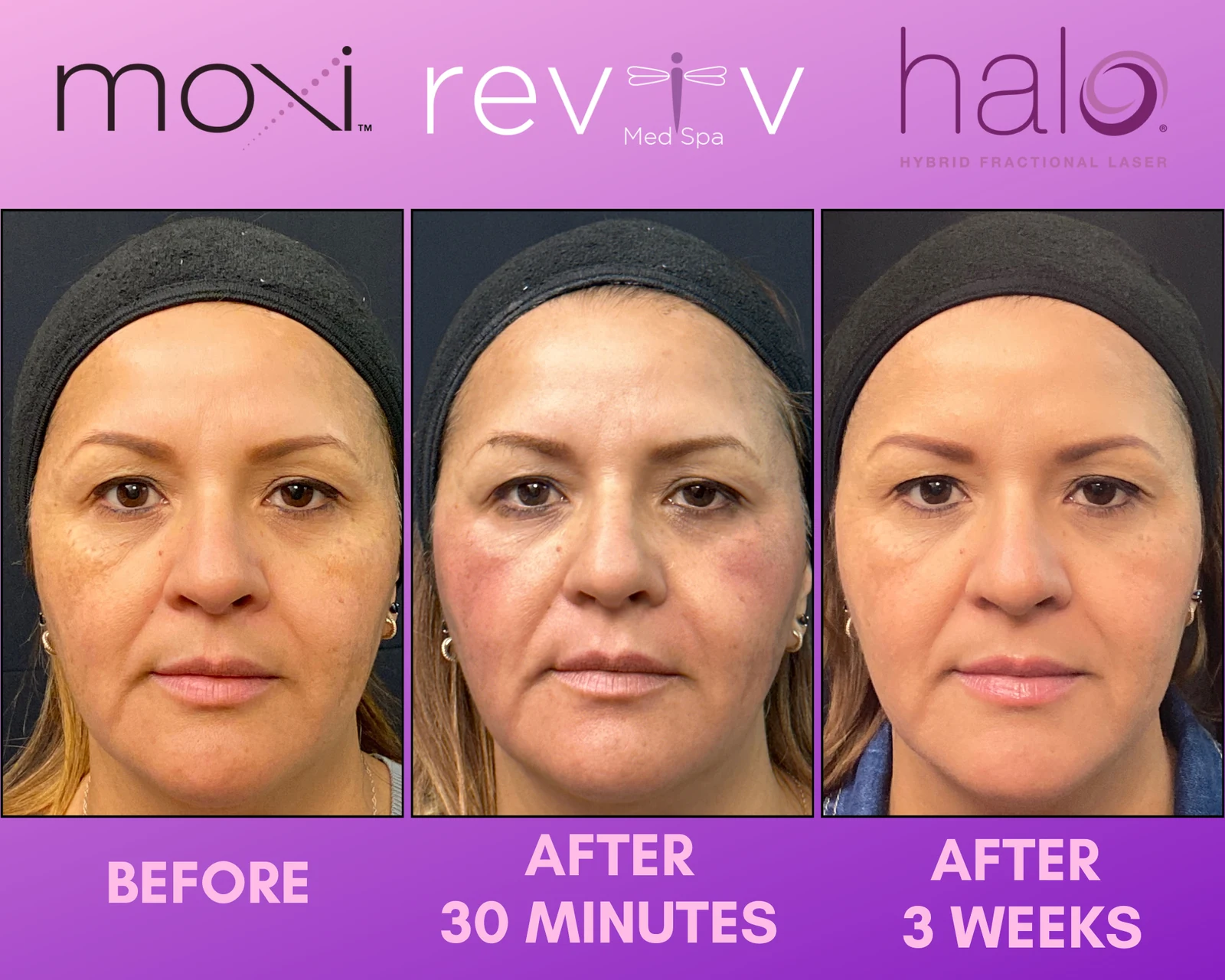 Reviv patient — Halo + MOXI (undefined)