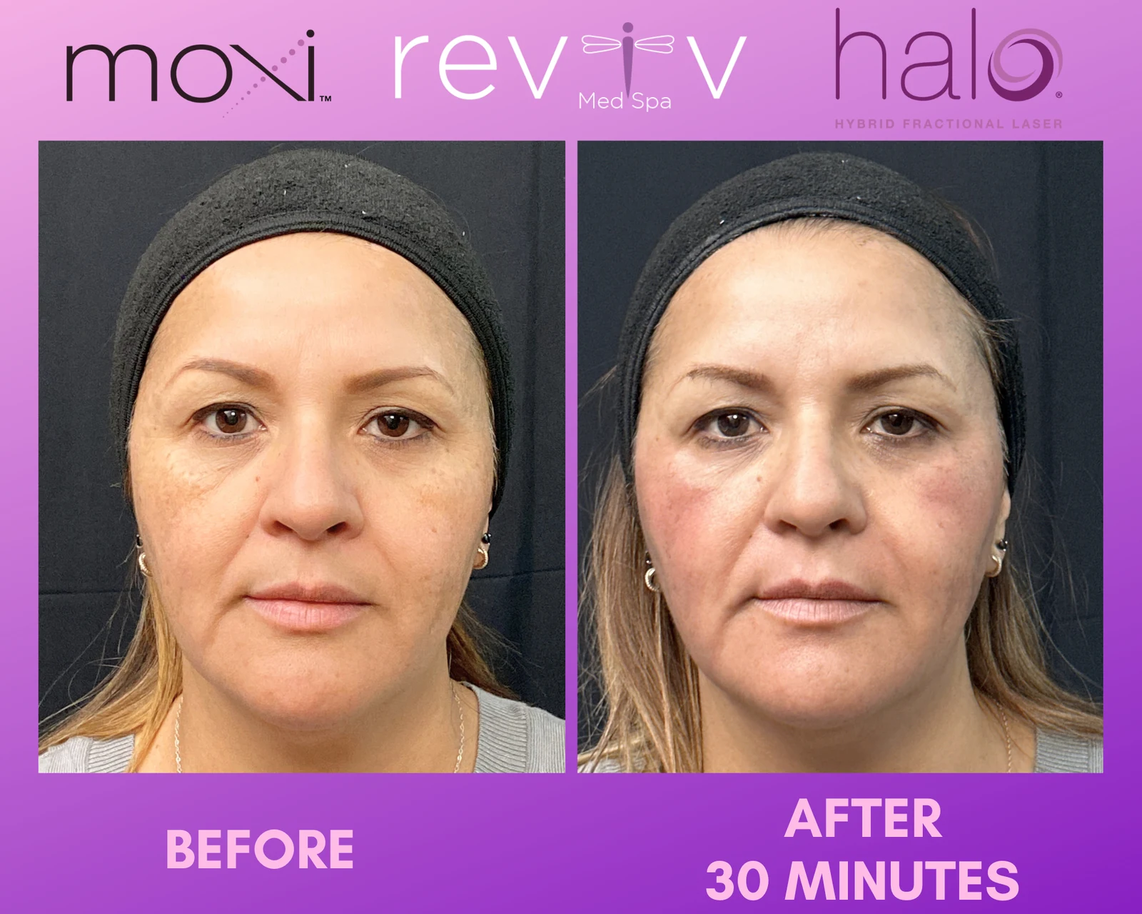 Reviv patient — Halo + MOXI (undefined)