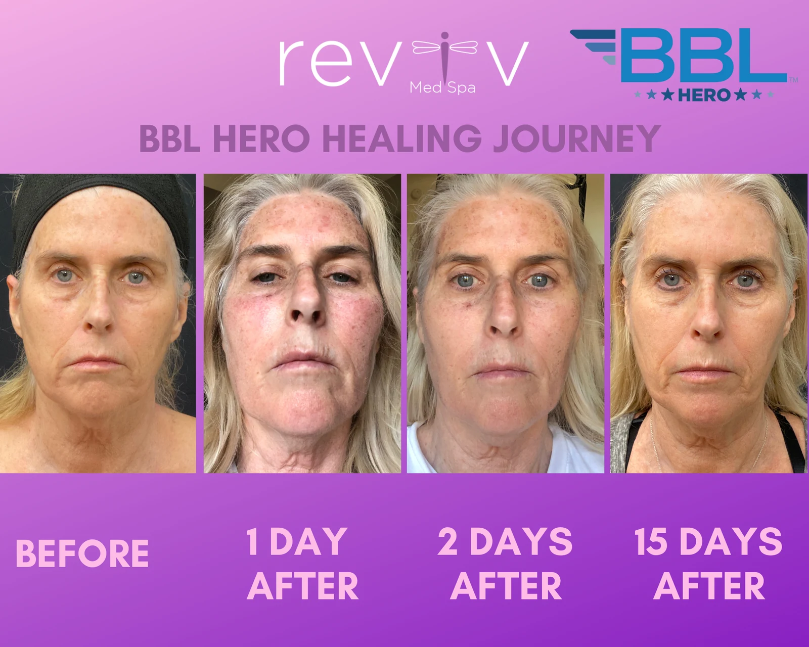 Reviv patient — BBL Hero (undefined)