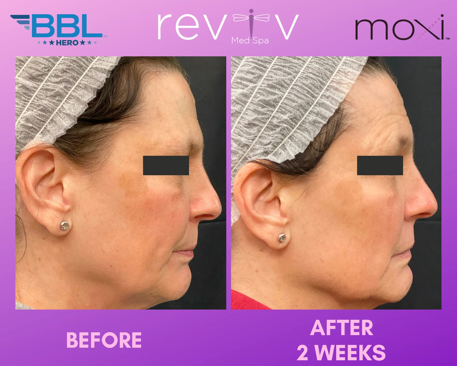 Reviv patient — BBL + MOXI (undefined)