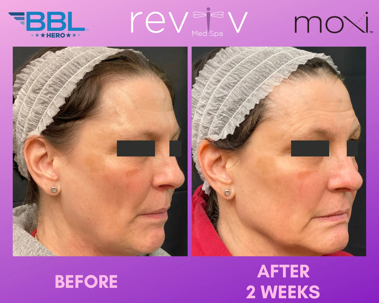 Reviv patient — BBL + MOXI (undefined)