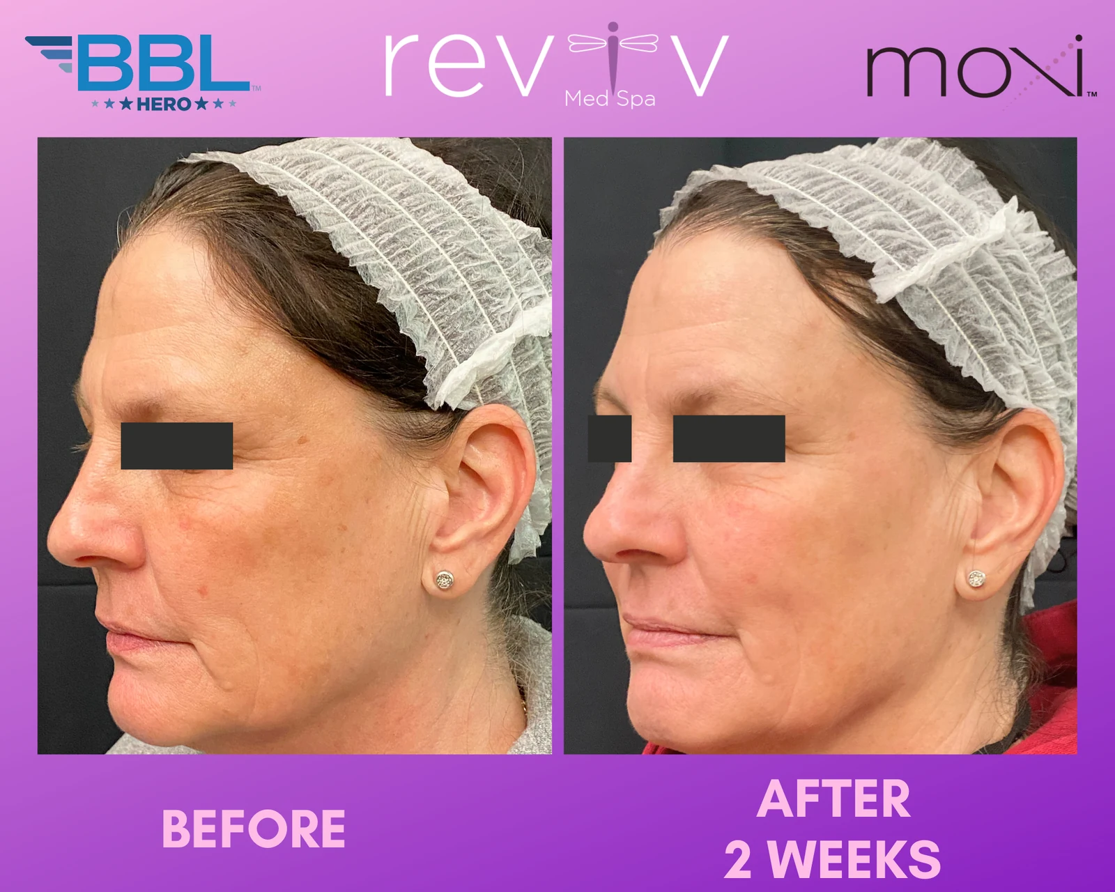 Reviv patient — BBL + MOXI (undefined)