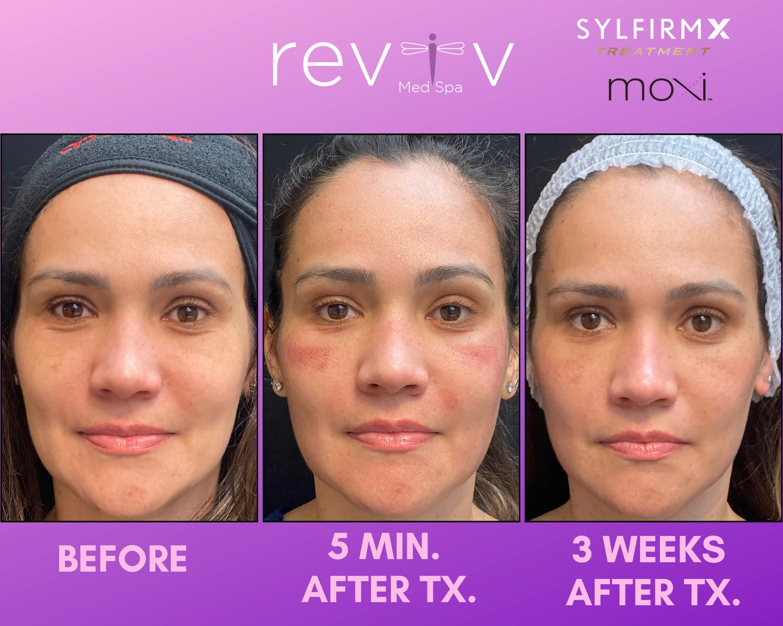 Reviv patient — MOXI + Sylfirm (undefined)