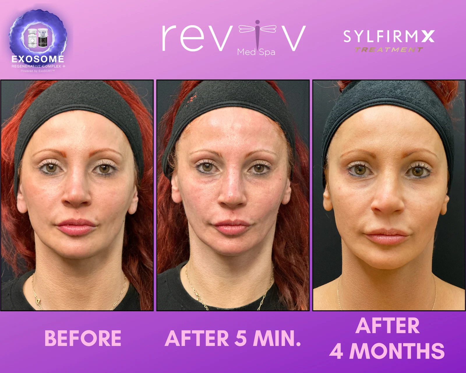 Reviv patient — Sylfirm X (undefined)