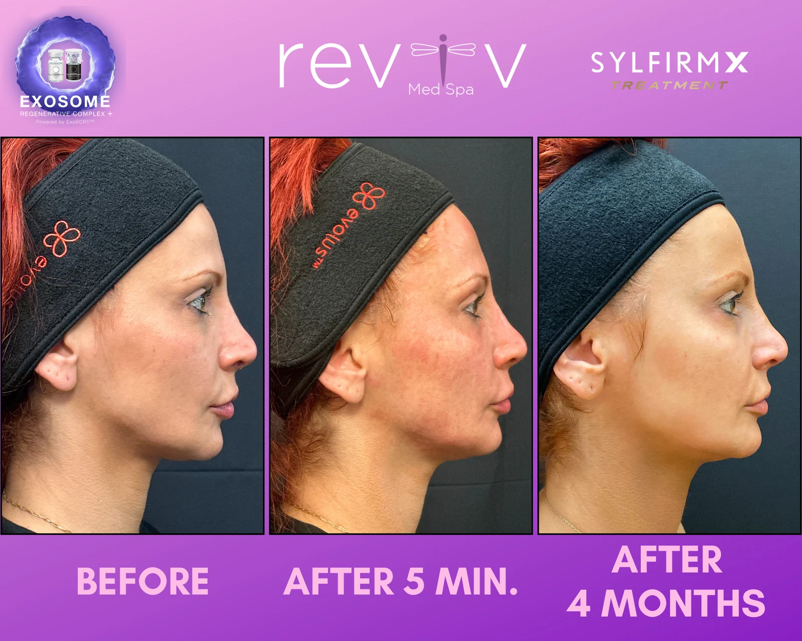 Reviv patient — Sylfirm X (undefined)