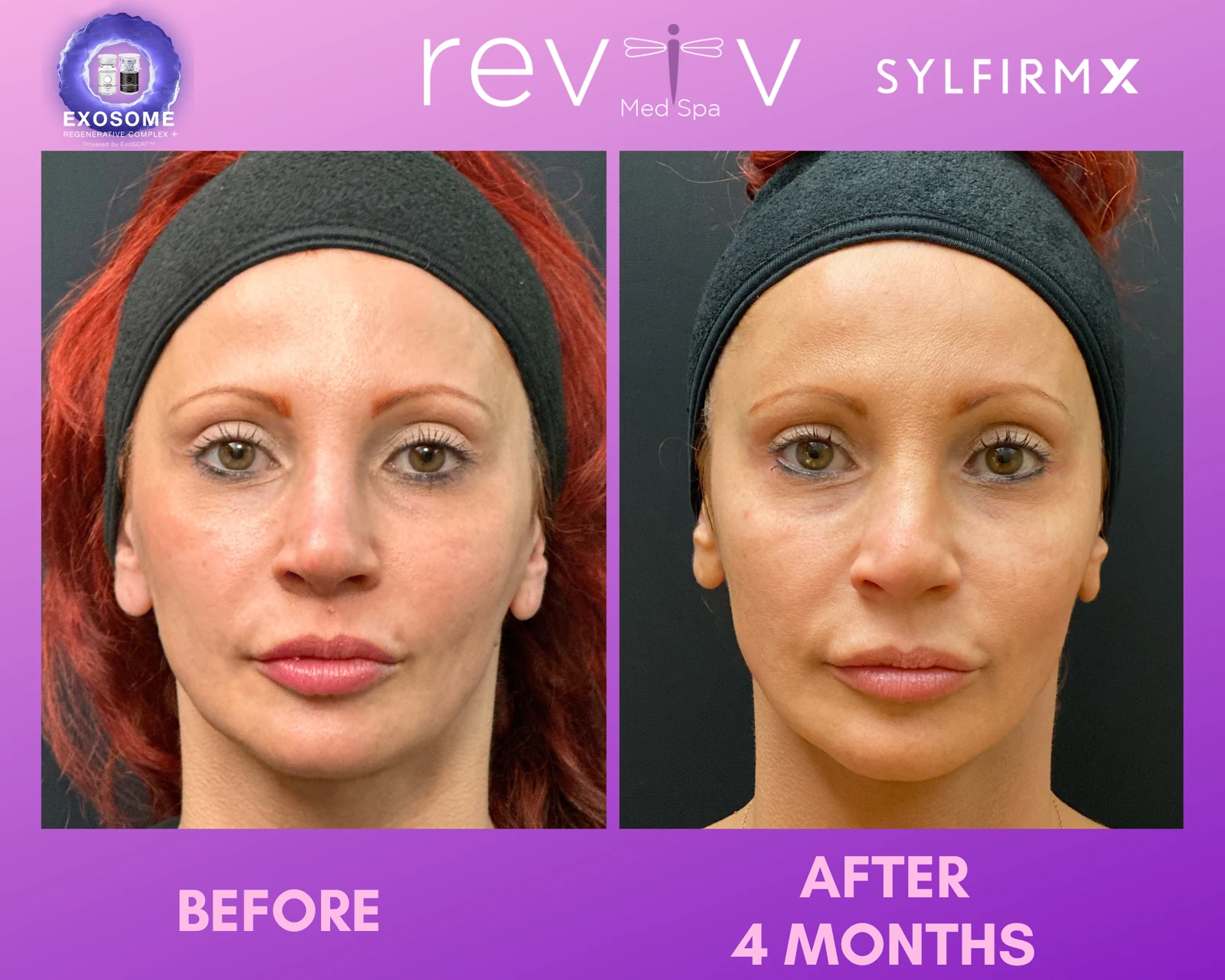 Reviv patient — Sylfirm X (undefined)