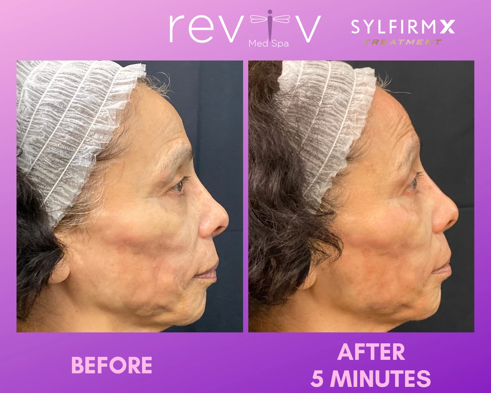 Reviv patient — Sylfirm X (undefined)