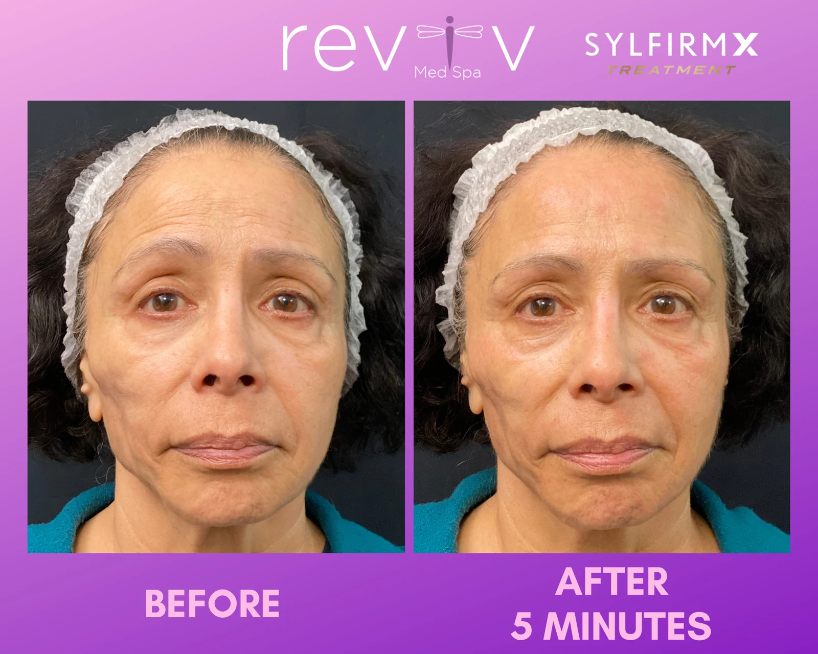 Reviv patient — Sylfirm X (undefined)