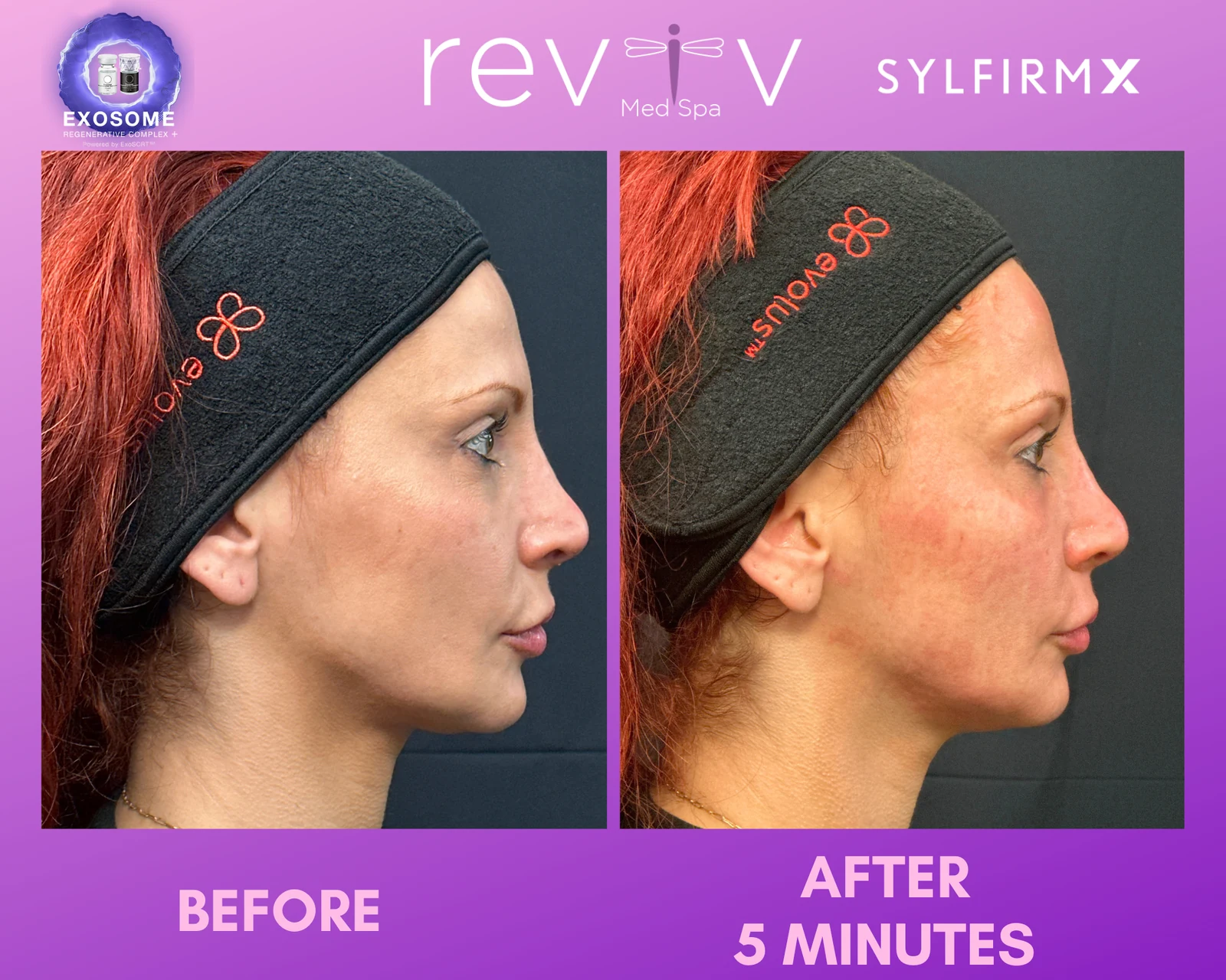 Reviv patient — Sylfirm X (undefined)
