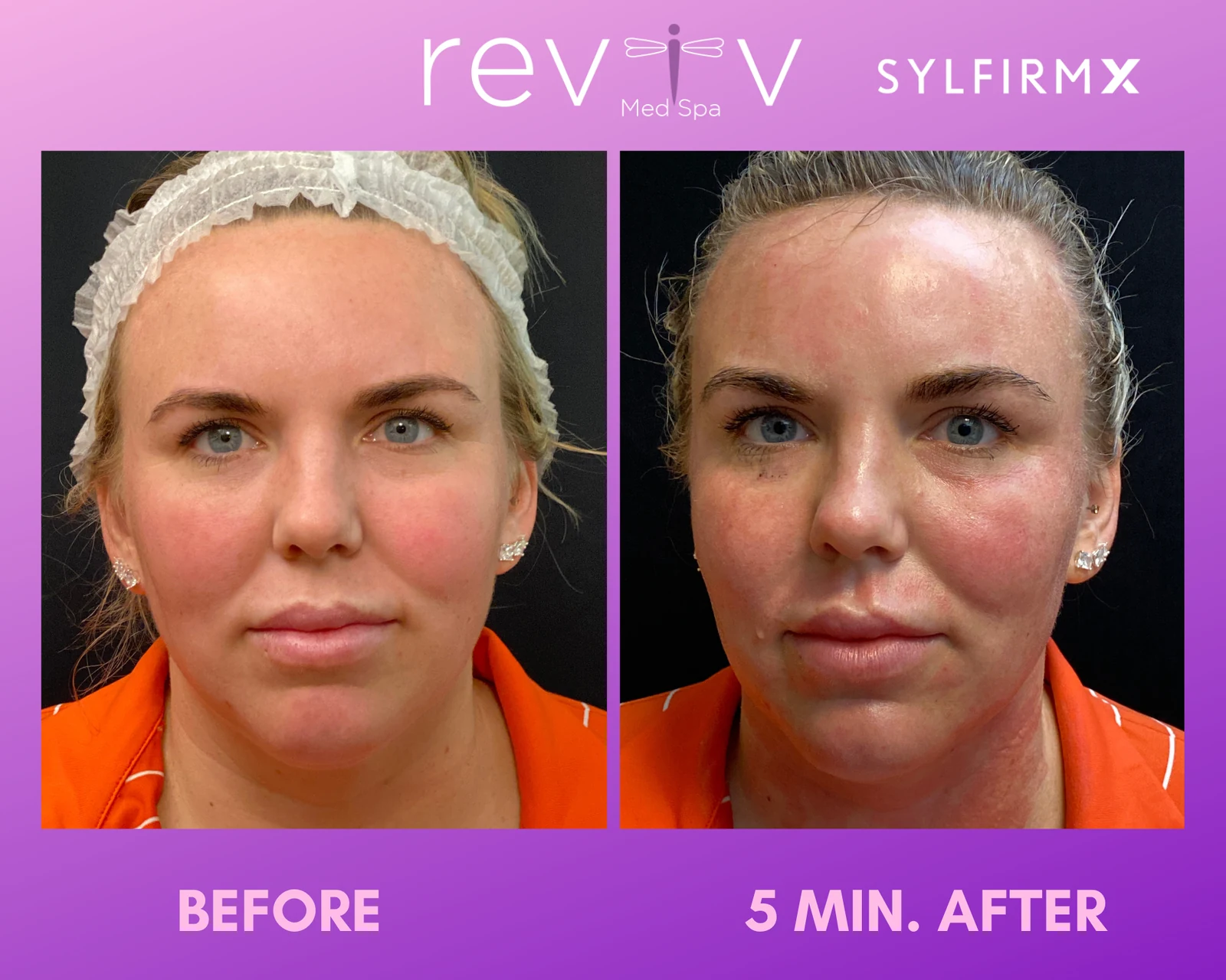 Reviv patient — Sylfirm X (undefined)