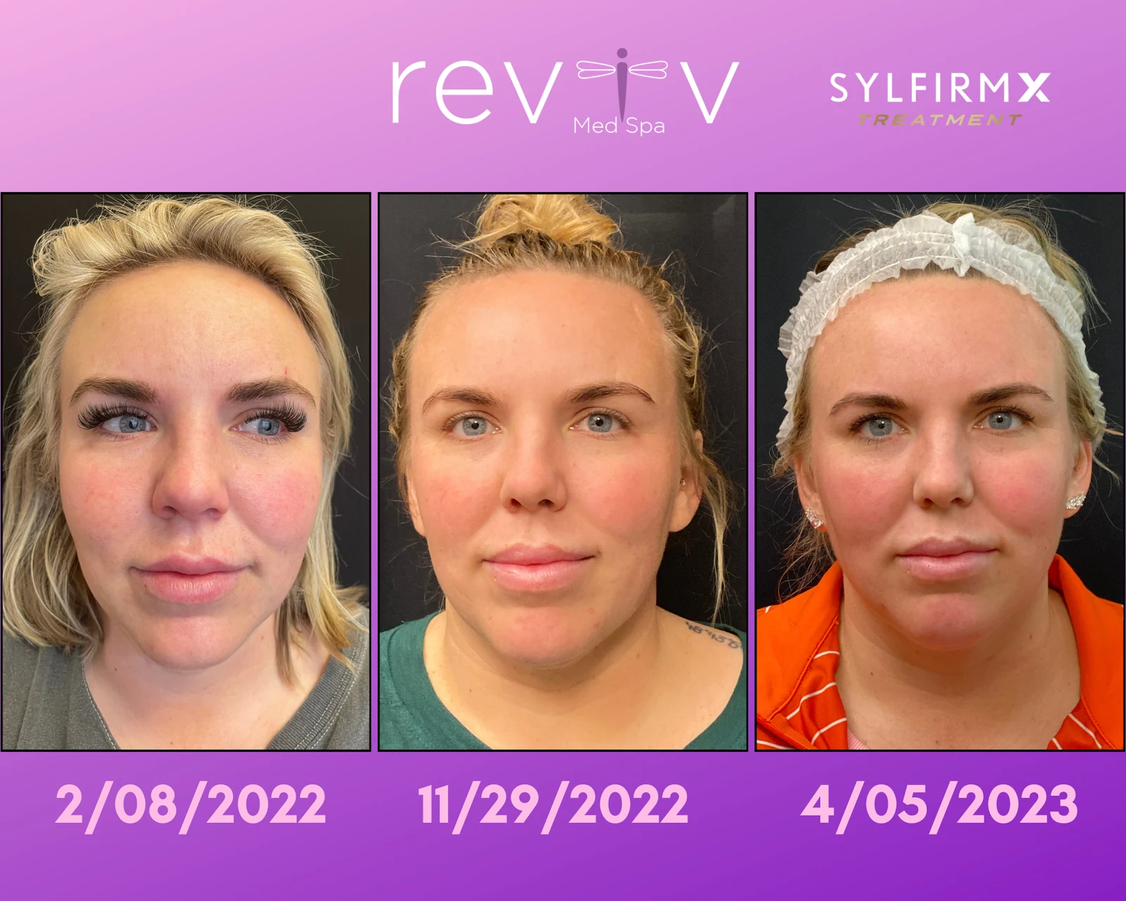 Reviv patient — Sylfirm X (undefined)