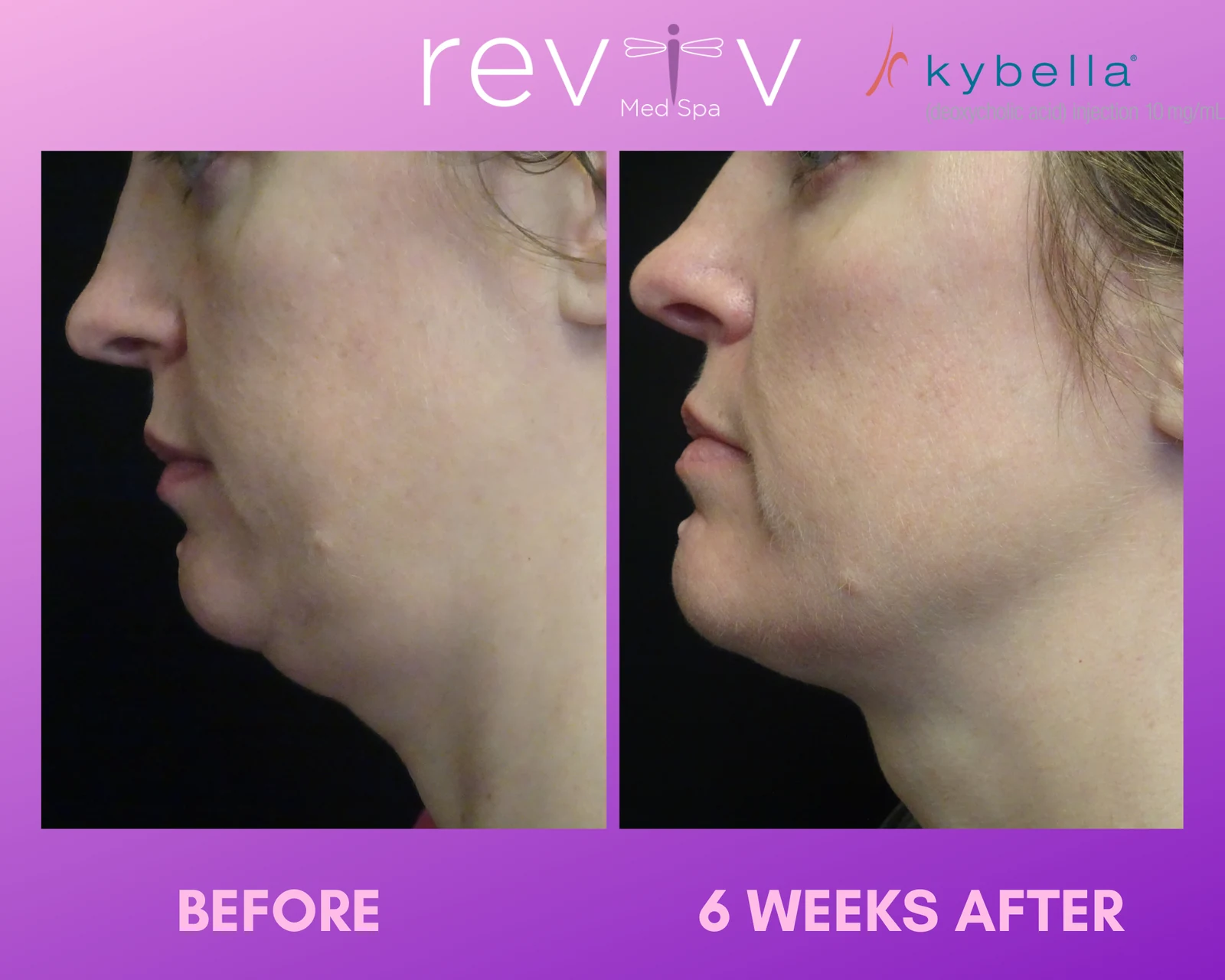 Reviv patient — Kybella (undefined)