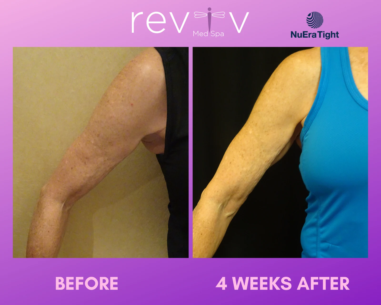 Reviv patient — NuEra Tight RF (undefined)