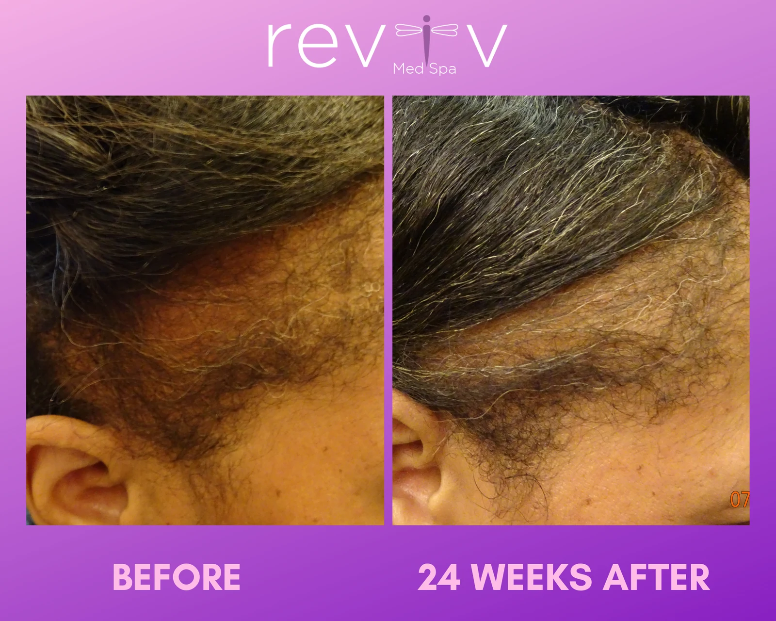Reviv patient — PRP Hair (undefined)