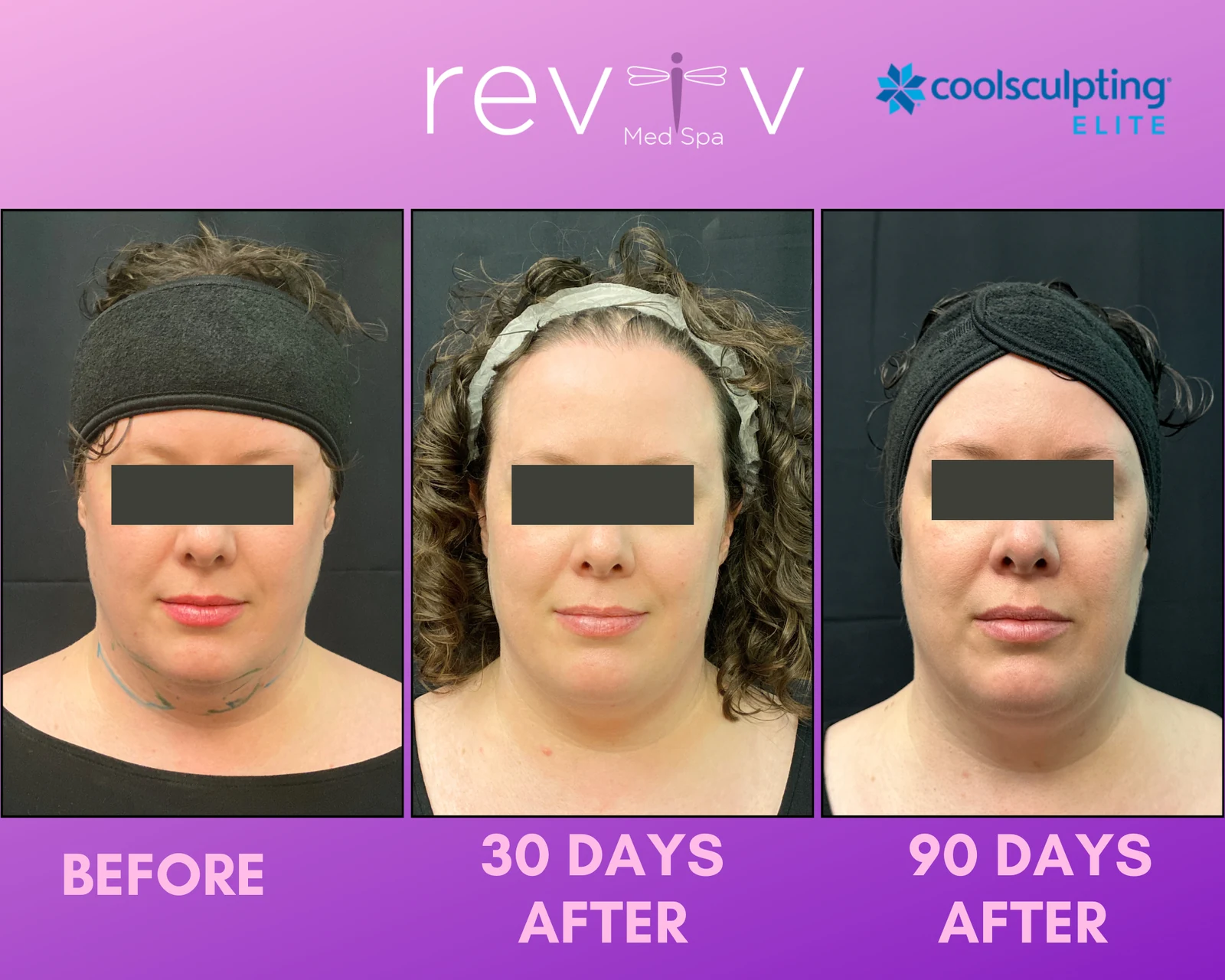 Reviv patient — CoolSculpting Elite (undefined)