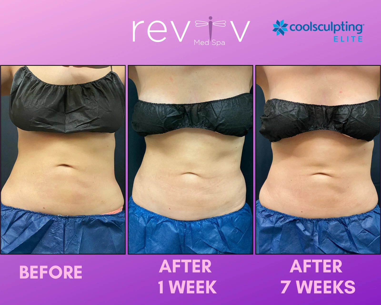 Reviv patient — CoolSculpting Elite (undefined)