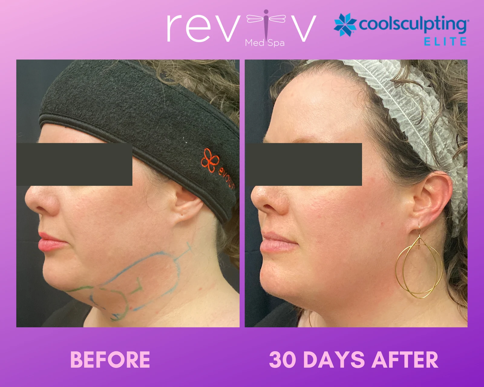 Reviv patient — CoolSculpting Elite (undefined)