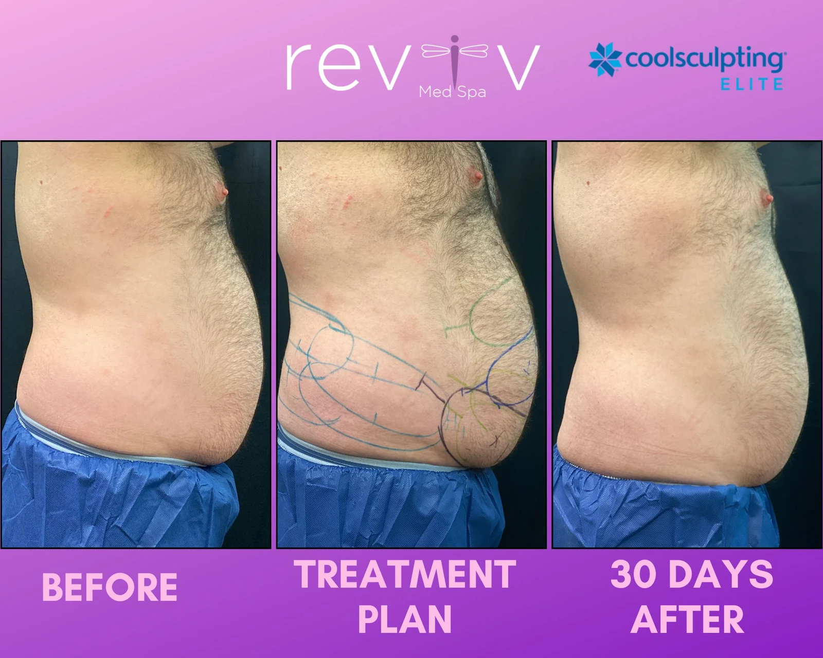 Reviv patient — CoolSculpting Elite (undefined)