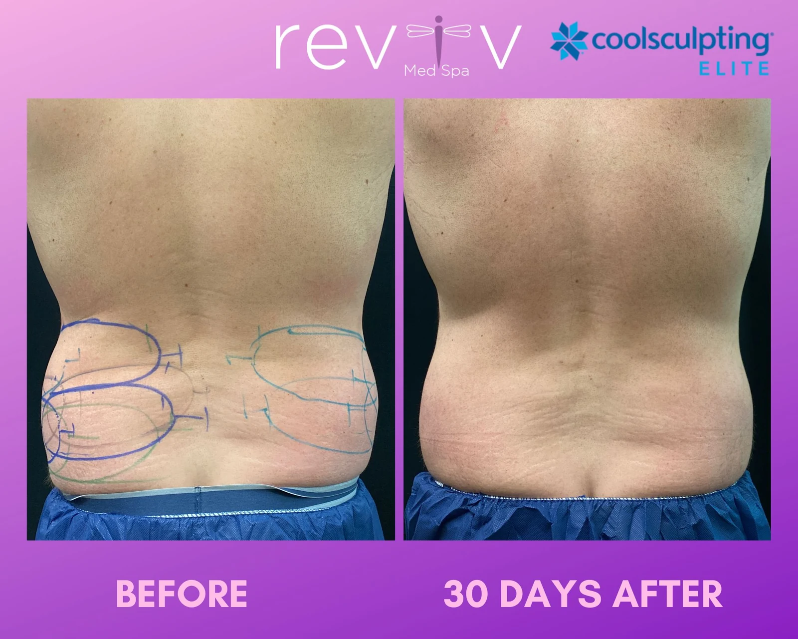 Reviv patient — CoolSculpting Elite (undefined)