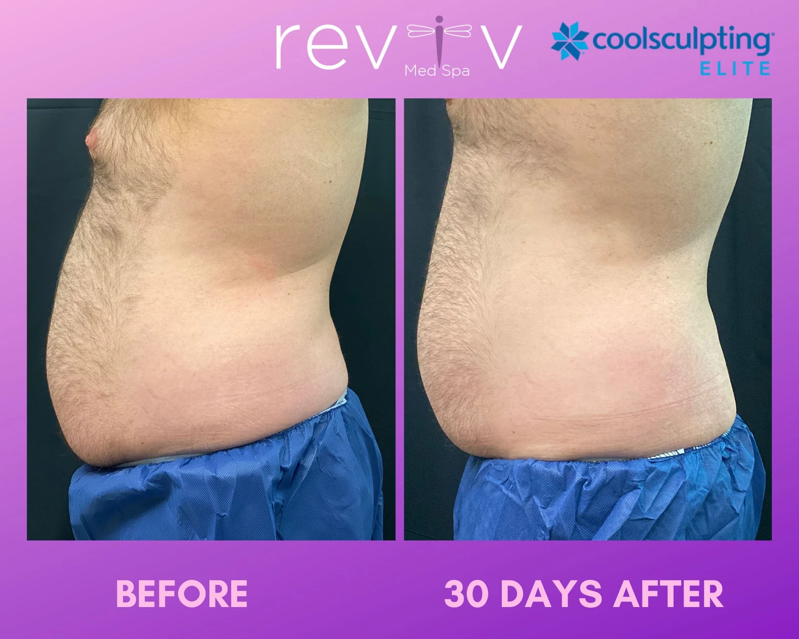 Reviv patient — CoolSculpting Elite (undefined)