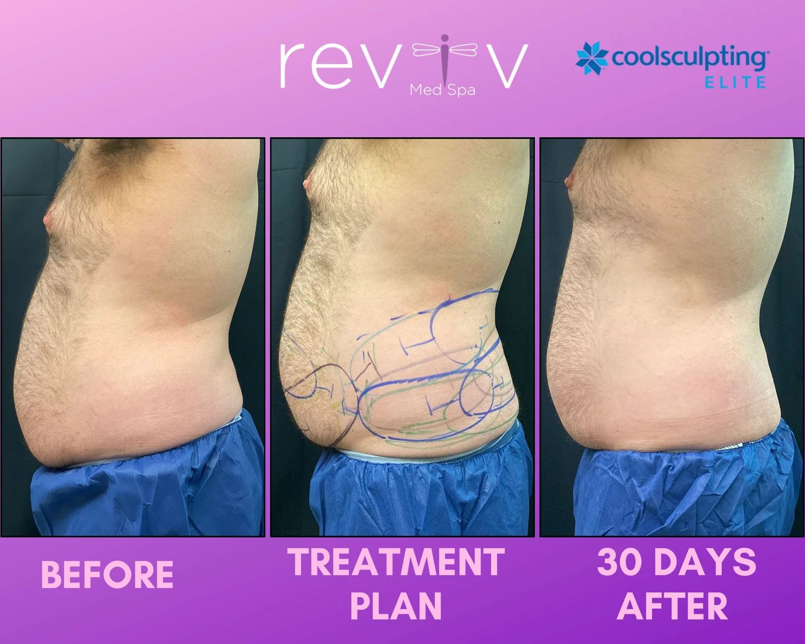 Reviv patient — CoolSculpting Elite (undefined)