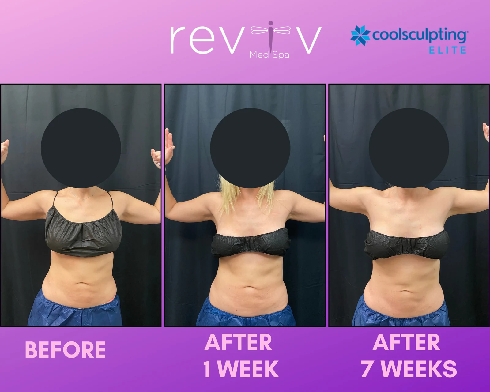 Reviv patient — CoolSculpting Elite (undefined)
