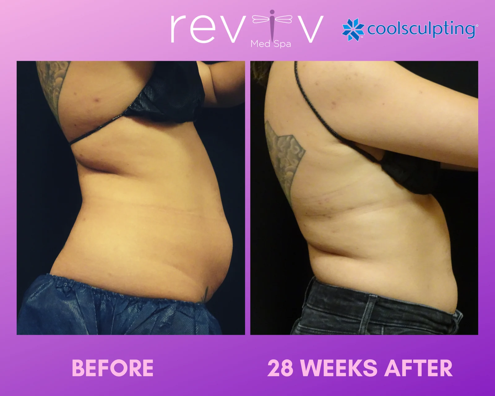 Reviv patient — CoolSculpting Elite (undefined)
