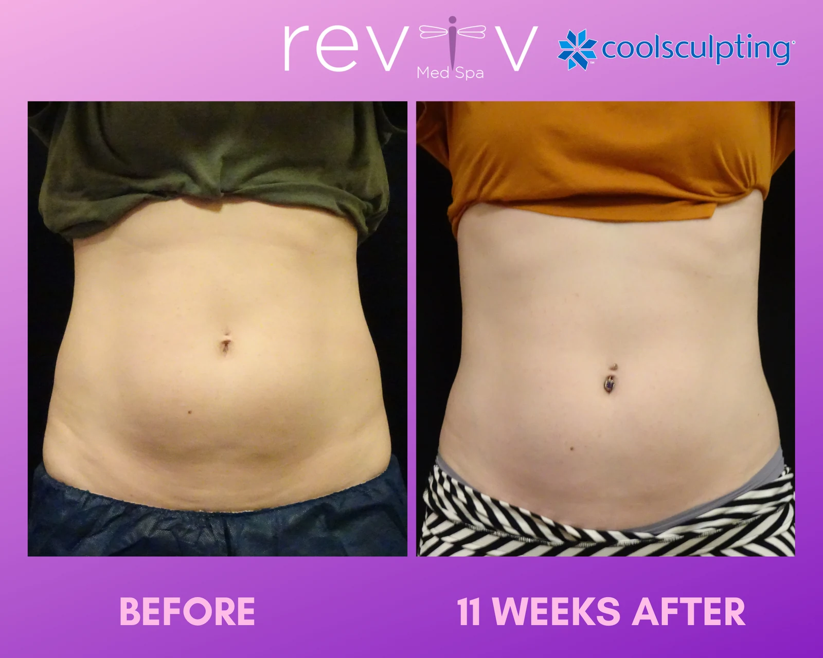 Reviv patient — CoolSculpting Elite (undefined)