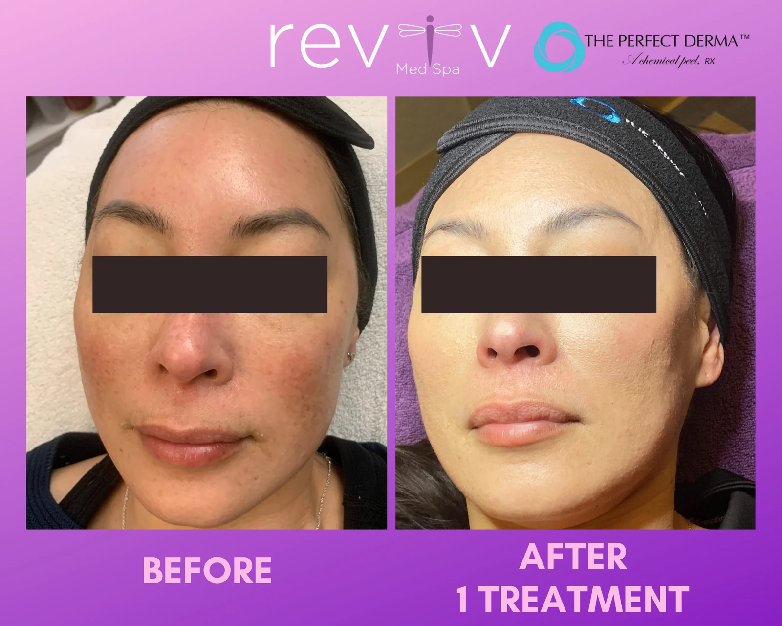 Reviv patient — Chemical Peel (undefined)