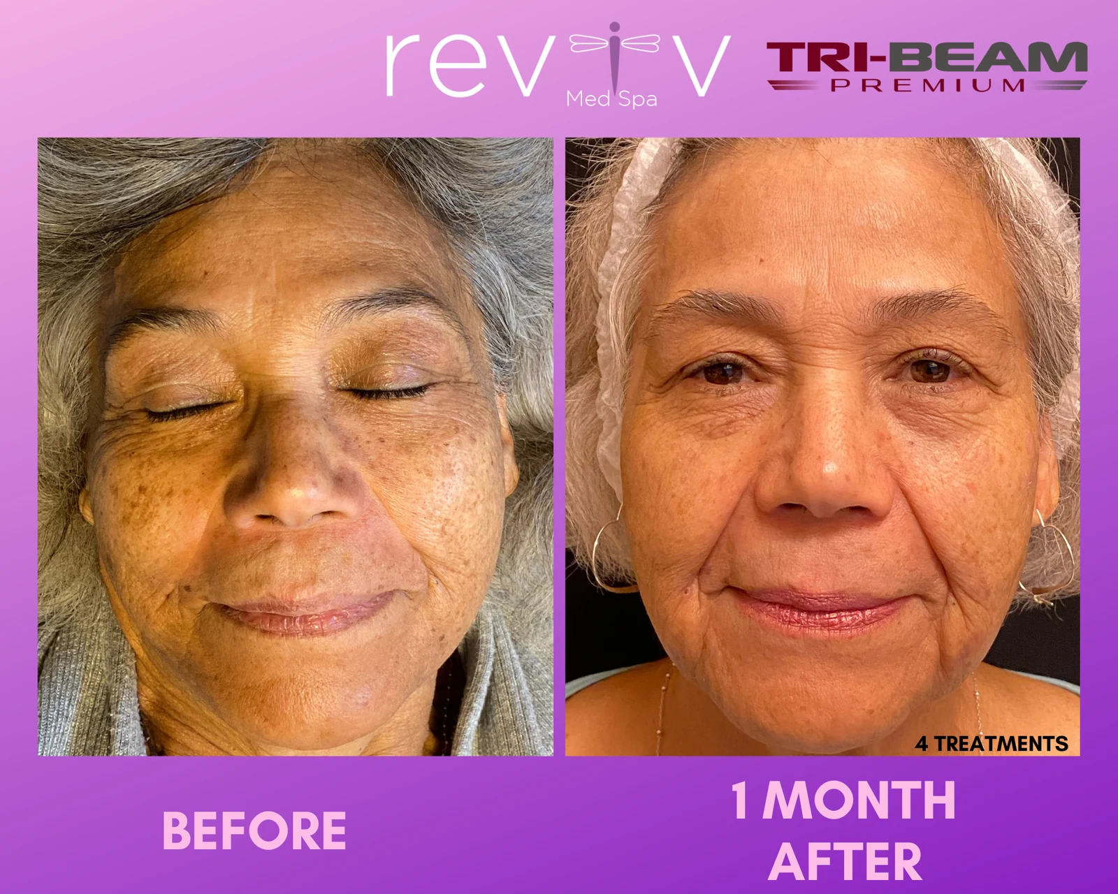 Reviv patient — TriBeam Pigment (undefined)