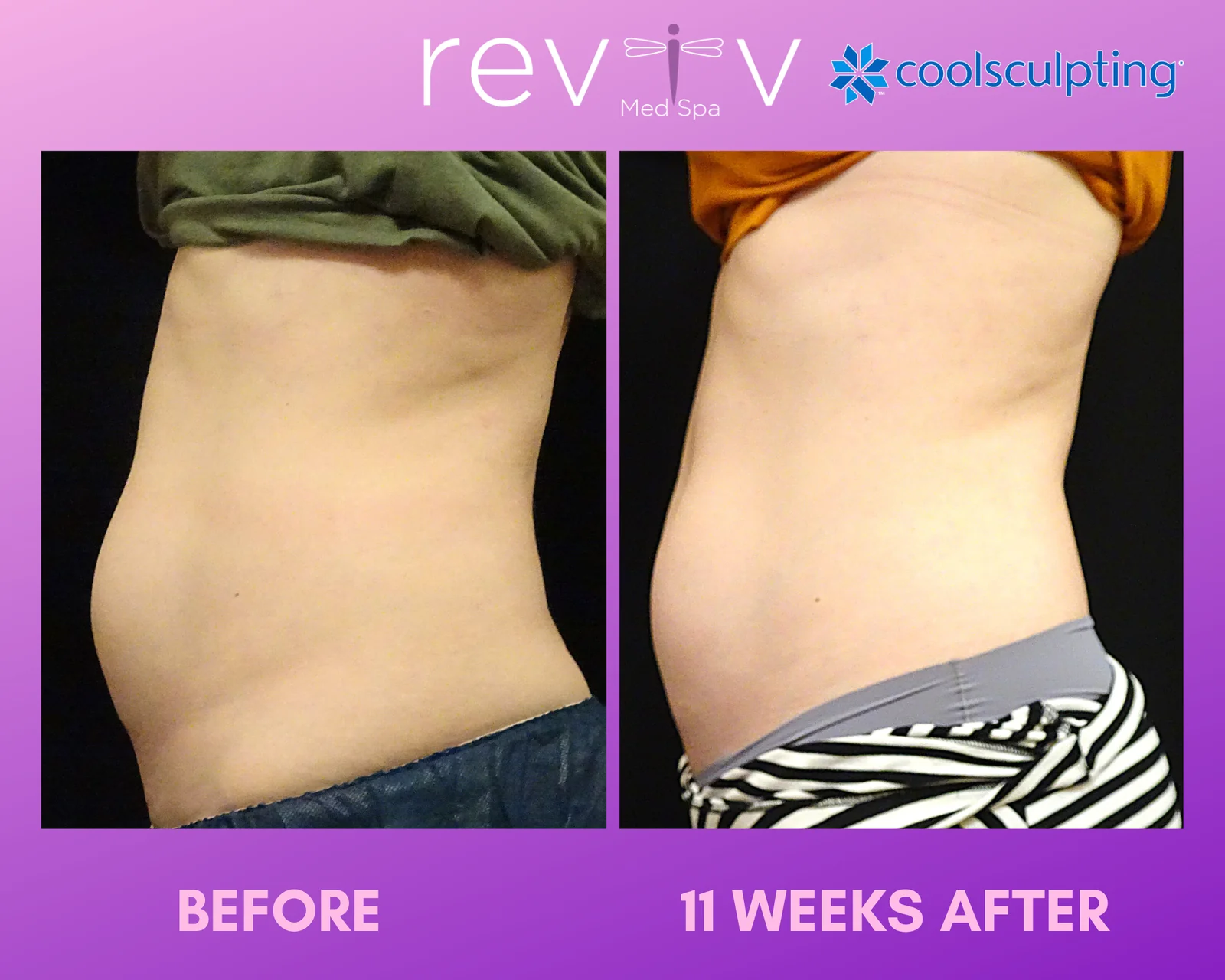 Reviv patient — CoolSculpting Elite (undefined)