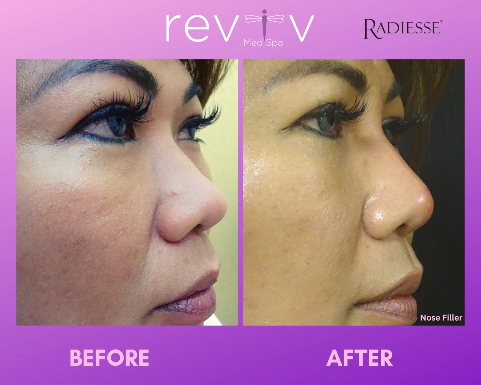 Reviv patient — Dermal Fillers (undefined)