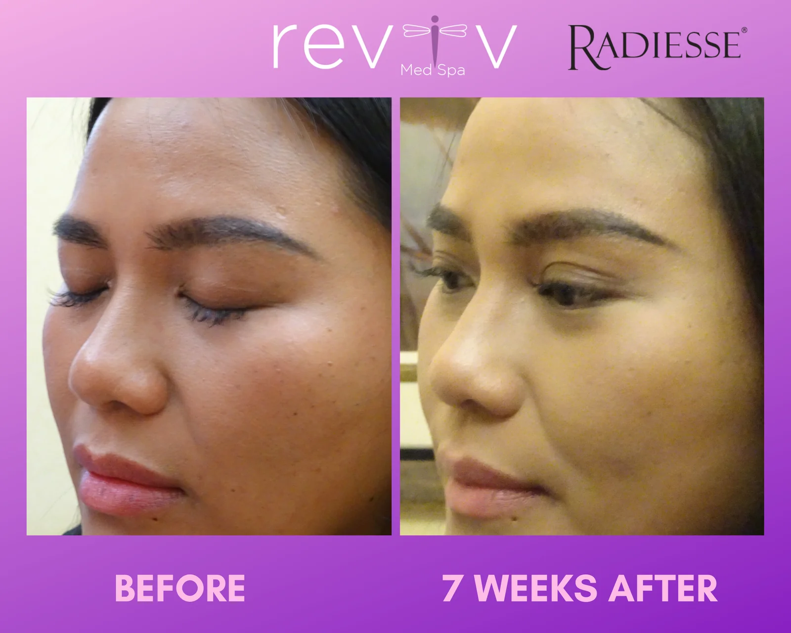 Reviv patient — Dermal Fillers (undefined)