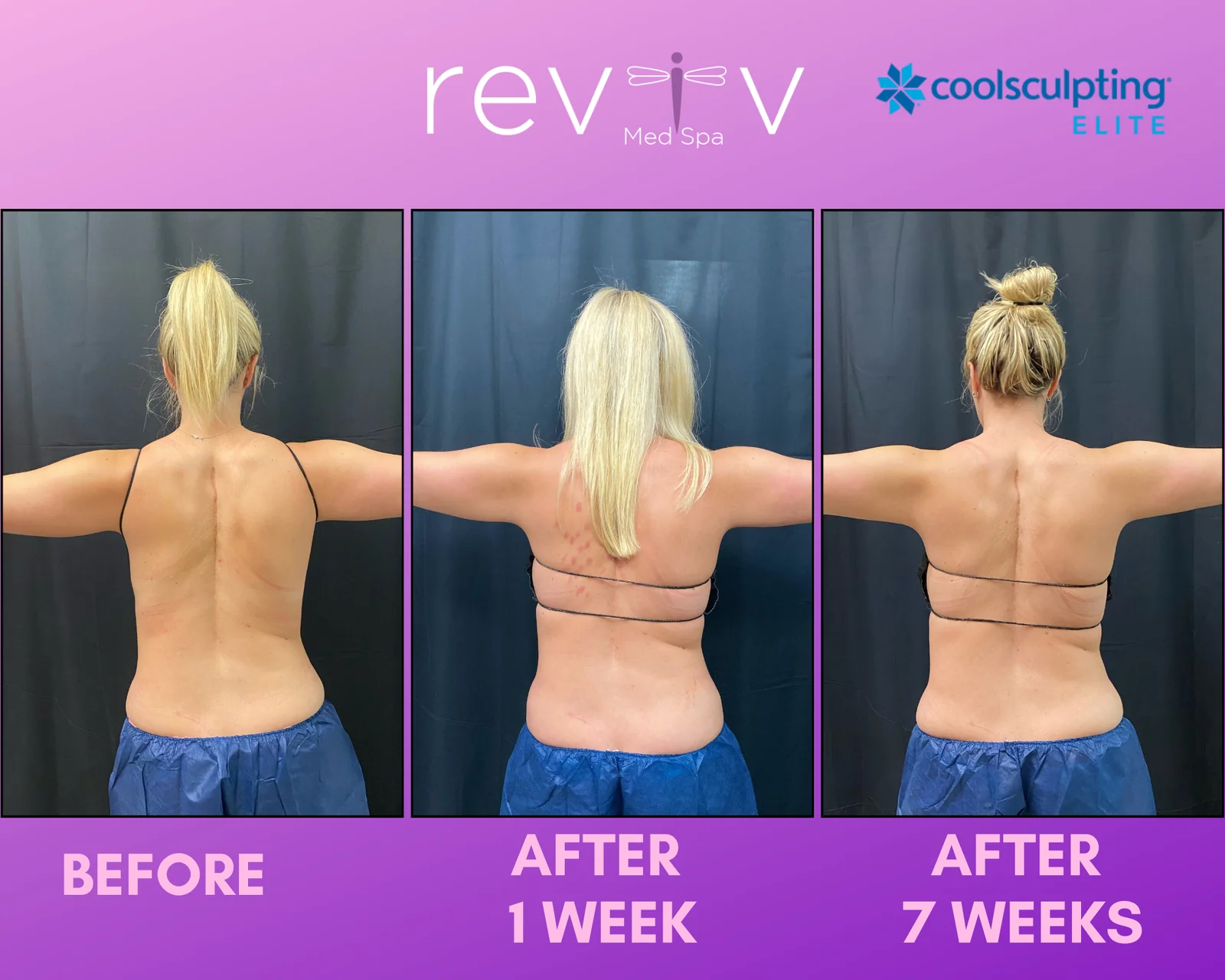 Reviv patient — CoolSculpting Elite (undefined)