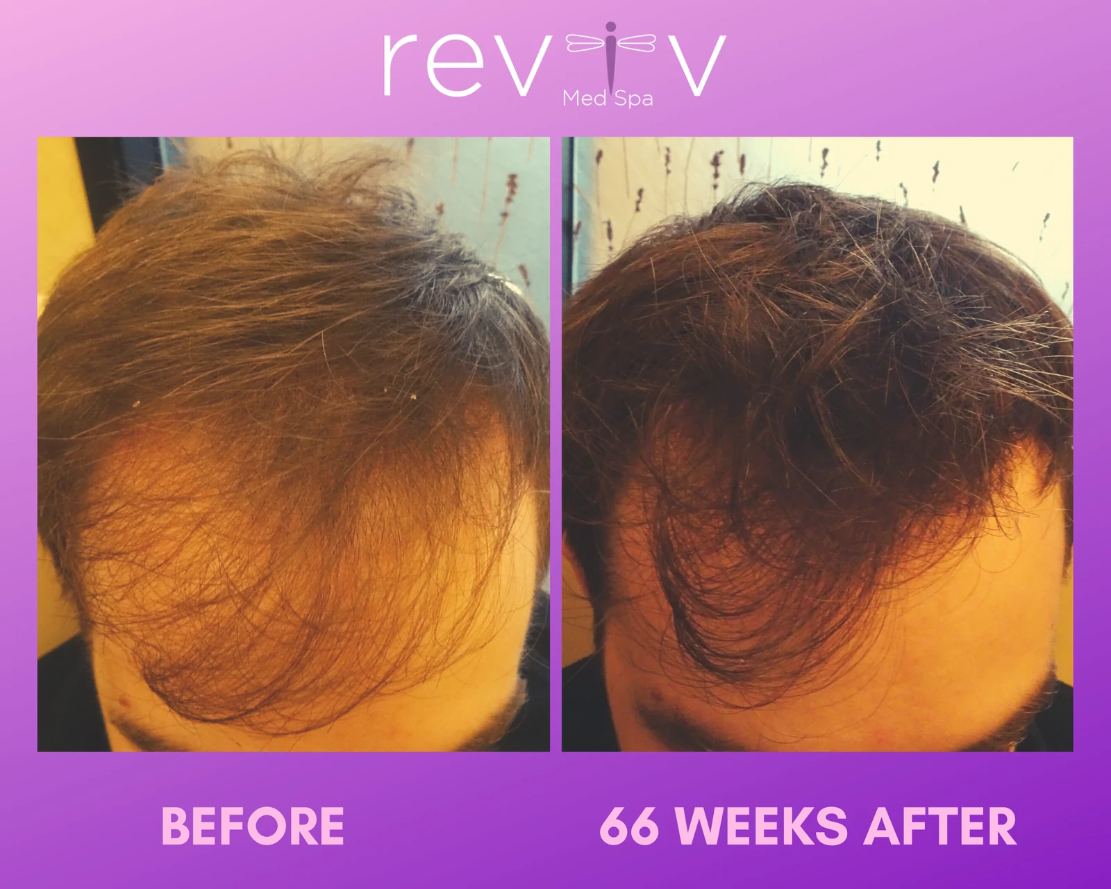 PRP hair restoration, before and 66 weeks after