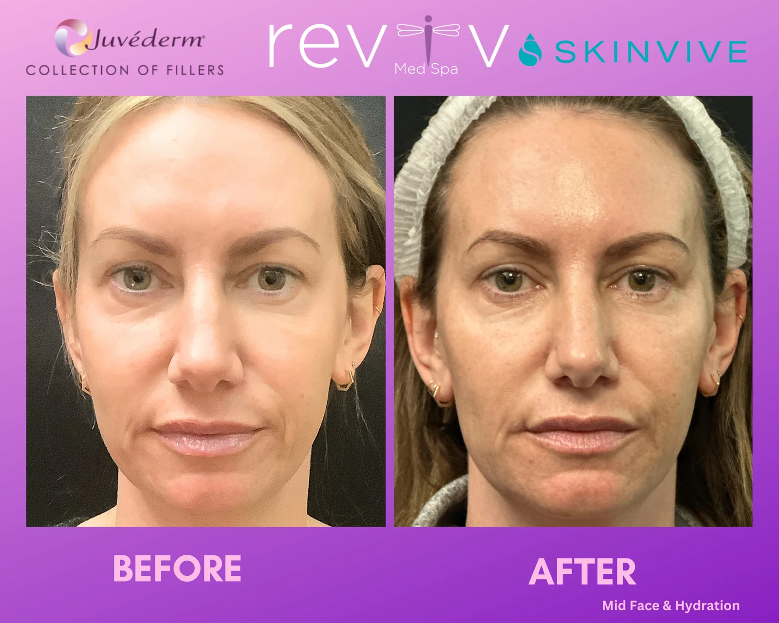 SkinVive microdroplet hydration, before and after