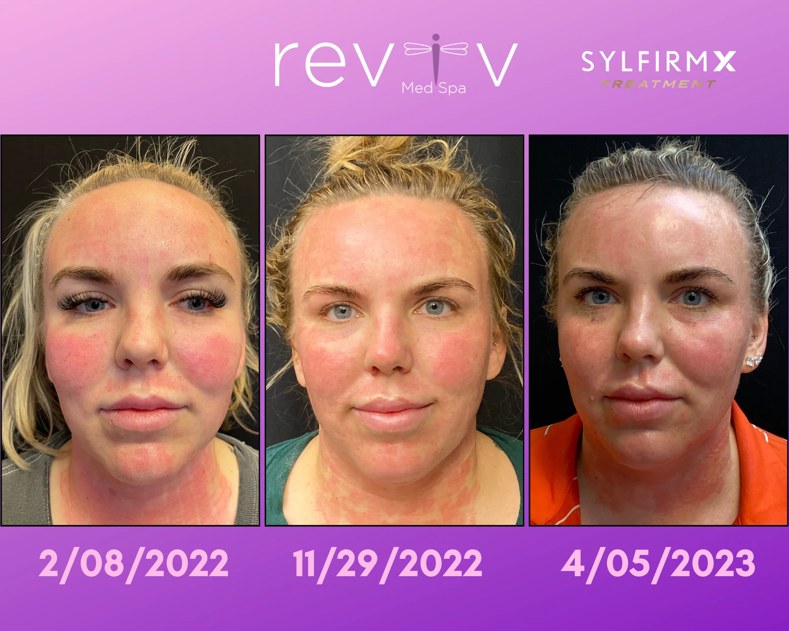Reviv Med Spa patient before and after — Sylfirm X, Millbrae, California