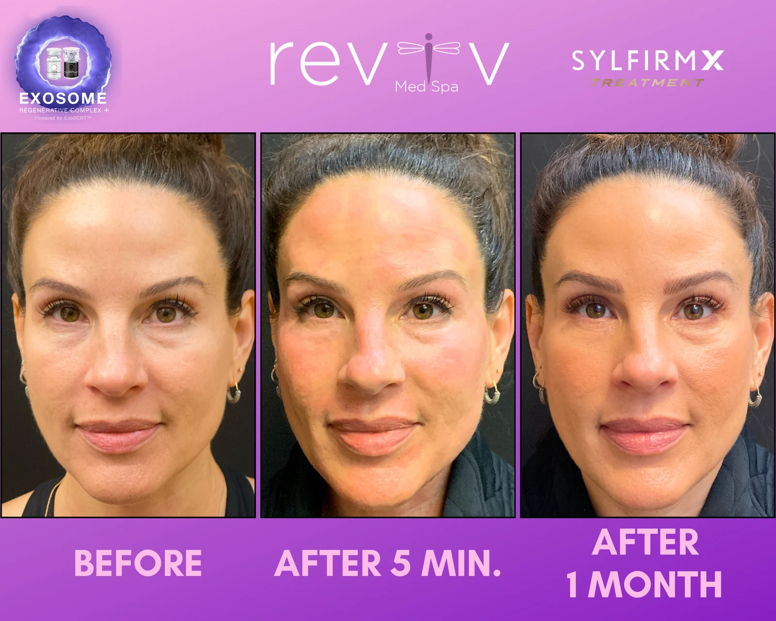 Sylfirm X RF microneedling before and after — after 5 minutes and after 1 month