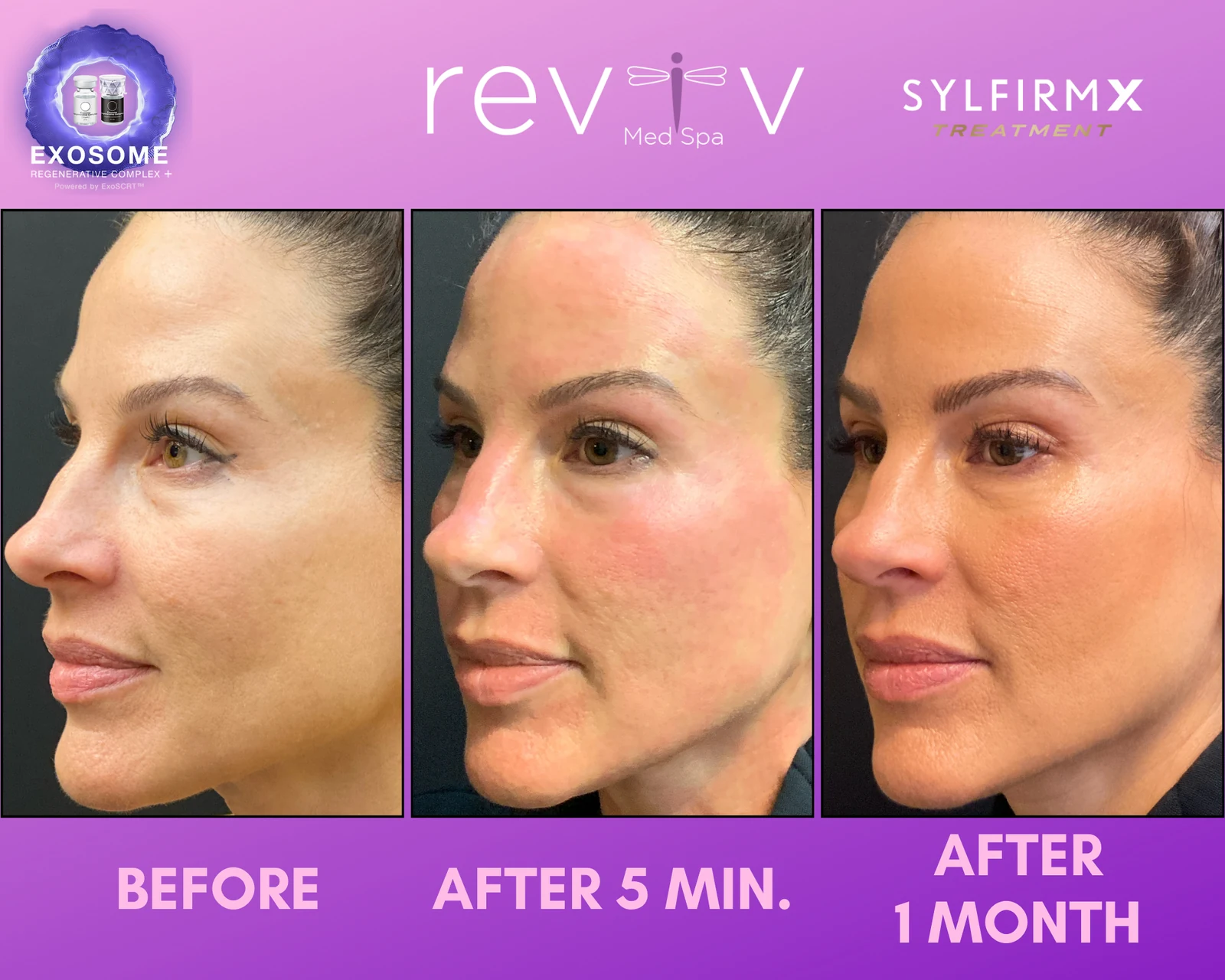 Reviv Med Spa patient before and after — Sylfirm X, Millbrae, California