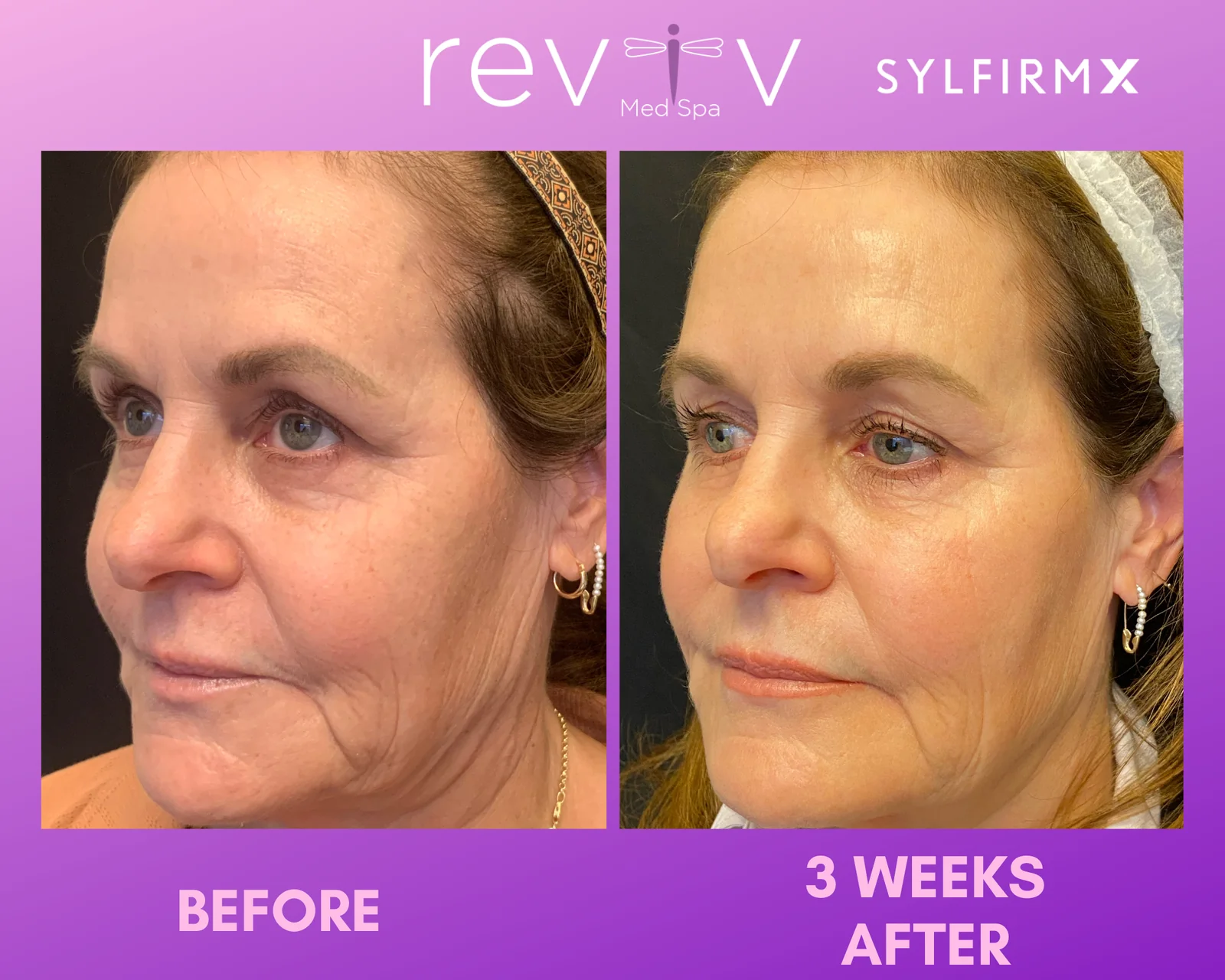 Reviv Med Spa patient before and after — Sylfirm X, Millbrae, California
